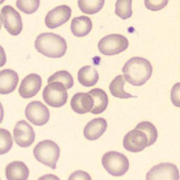 Schistocytes 