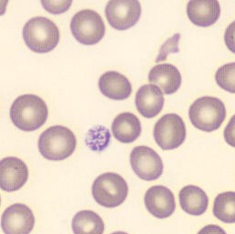 Schistocytes 