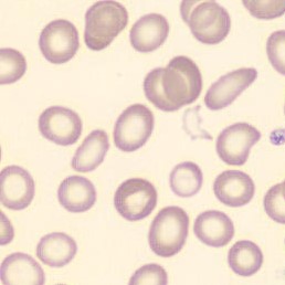 Schistocytes | CellWiki