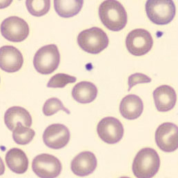 Schistocytes | CellWiki